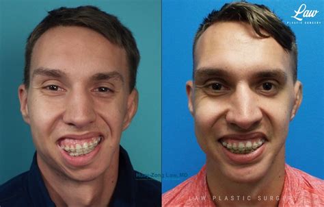 Jaw Surgery Before & After Photos - Law Plastic Surgery