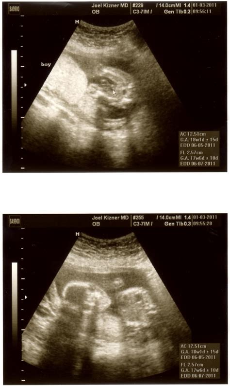 Growing Jacobsons: 17 week ultrasound/OB visit