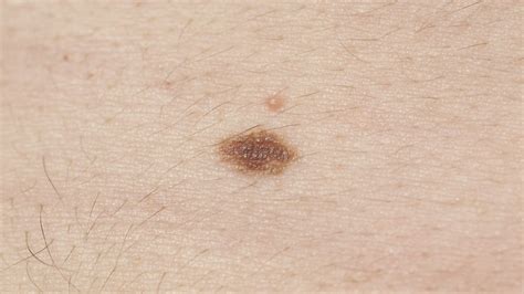 Melanoma symptoms: How to spot signs, and when to see a doctor