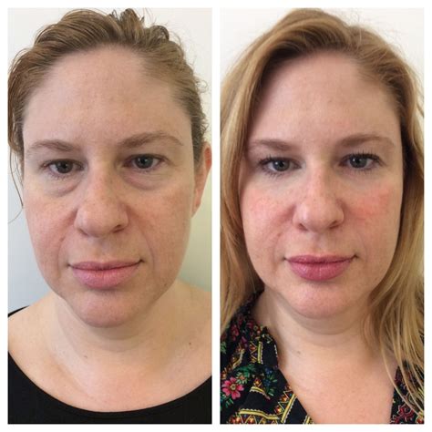 Westside Aesthetics Non Surgical Face Lift | Cosmetic surgery, Rhinoplasty, Beauty magazine