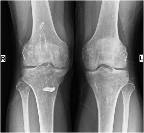 Cureus | Current Trends in Anterior Cruciate Ligament Reconstruction: A Review