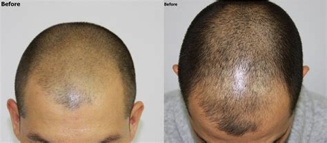 Hair Restoration Progression and Hair Growth Timeline - Alvi Armani ...