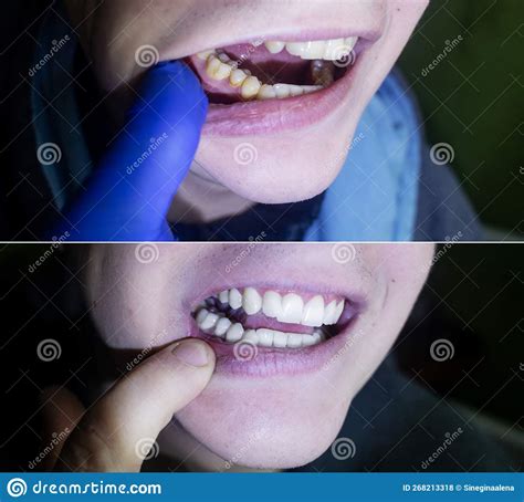 Tartar Removal. before and after the Procedure for Cleaning the Tooth Enamel from Plaque and ...