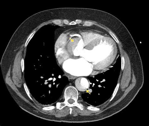 Aortic Dissection (Spontaneous)