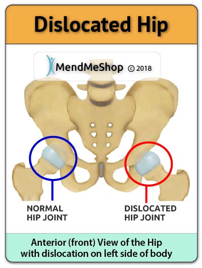 Hip Dislocation Information