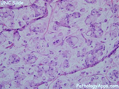 signet ring carcinoma colon histology