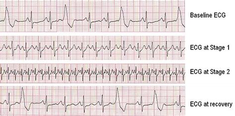 Chronic stable angina exercise electrocardiography - wikidoc