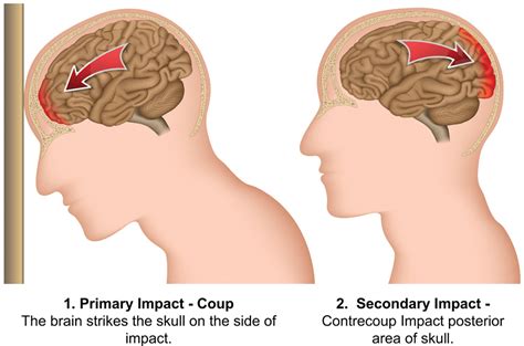 Coup Contrecoup Brain Injury - Charlie Waters Law