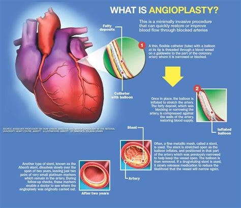 escanear Campo Polar blocked artery in heart stent Lima trolebús arcilla