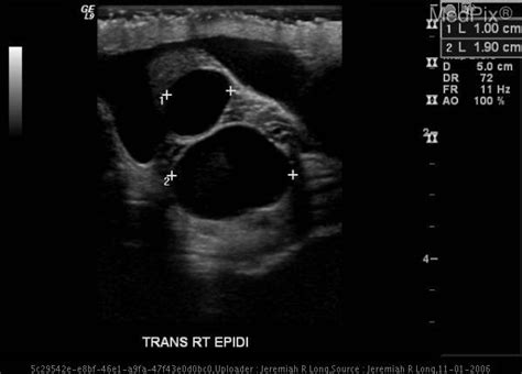 Epididymal Cyst