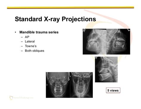 Imaging of Facial Trauma