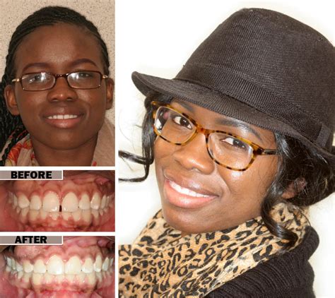 Cracked Retainer - Dentist in Brooklyn
