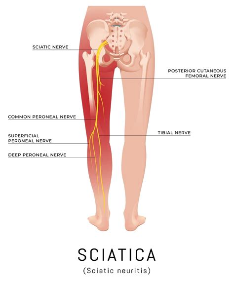 Sciatica, Lower Back Pain & the Sciatic Nerve