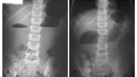 Congenital Duodenal Web Leading to Partial Obstruction | CausaPedia - Hakemli Olgu Dergisi