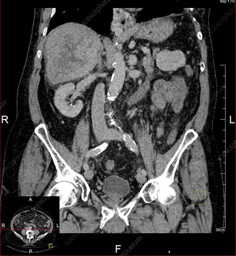 Liver cancer, CT scan - Stock Image - C019/9566 - Science Photo Library