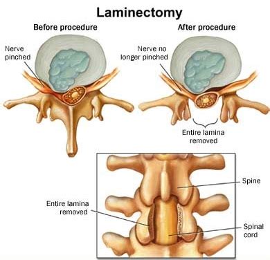 Erroneous Preclusion of Evidence Requires Retrial of Damages Verdict in Spinal Injury Case | New ...