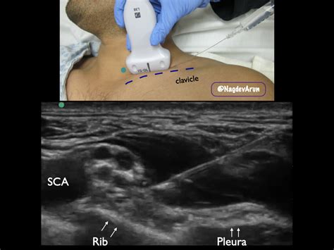 Supraclavicular Brachial Plexus — Highland EM Ultrasound Fueled pain ...