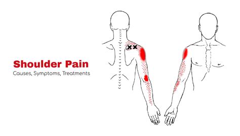 What Causes Pain In Arm From Shoulder To Wrist at Rebecca Nava blog