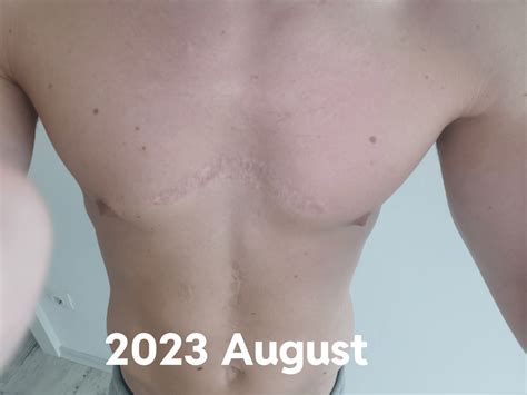 Keloids cured after 10 years trying : r/Keloids