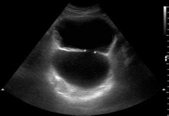 Ultrasound Case 072 • LITFL • POCUS Self-Assessment Quiz