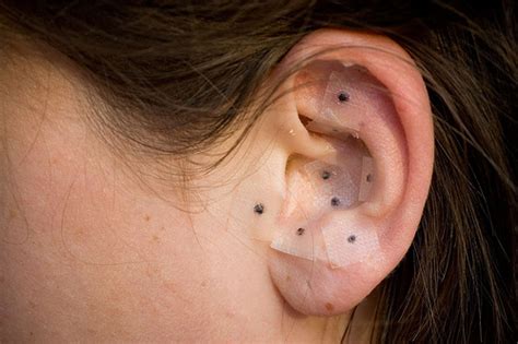 Acupuncture – Ear Seeds | Our Fertility Blog