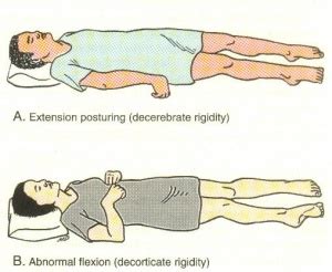 Hypertonicity vs Spasticity - Physiopedia