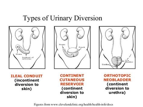 CARCINOMA URINARY BLADDER