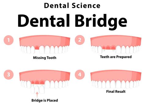 Front Teeth Crowns Before and After | Transforming Smiles