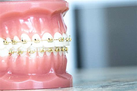 What are the Benefits of Gold Braces for Teeth? - shoreshim