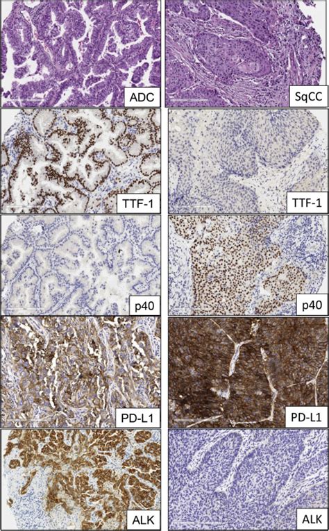 Lung Cancer Biomarkers | Oncohema Key