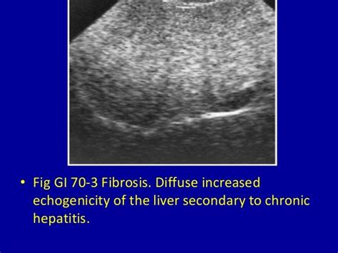 70 generalized increased echogenicity of the liver