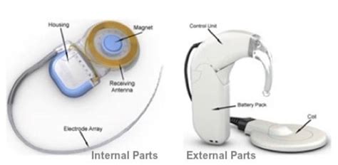 What is a Cochlear Implant? Understand the functions | EarGuru