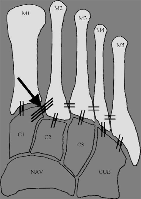 Lisfranc Ligament Anatomy