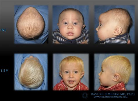 Metopic Synostosis Facts and Photos | Craniosynostosis