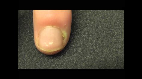 A finger infection near the nail bed or Paronychia as it is called ...