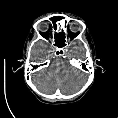 Ct facial bones - Skull, Head, and Neck CTs - embodi3D.com