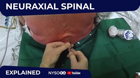 Neuraxial Spinal Anesthesia Ultrasound assisted - Regional anesthesia Crash course with Dr ...