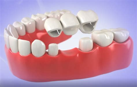 Dental bridges for missing teeth | Costa Mesa, CA | Dentistry At Its Finest