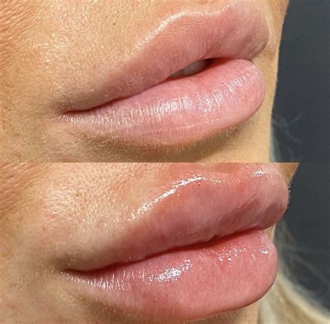 Advanced Lip Fillers including Russian Lip - Medics and Non-Medics ...