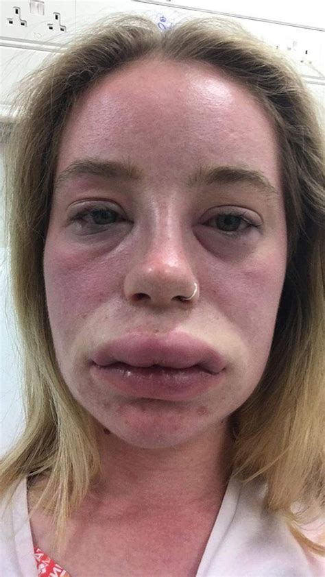 FOX NEWS: Woman left suffering from swollen lips full-body rash for weeks due to mysterious ...