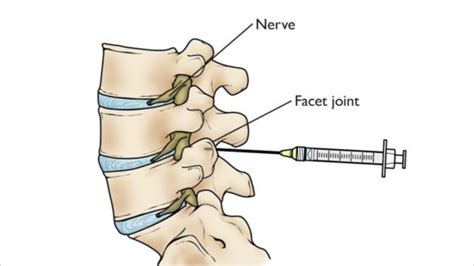 What is a Facet Joint Injection? | Centeno-Schultz Clinic