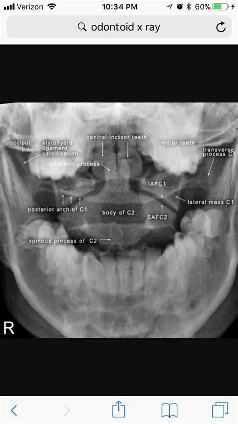 Radiographic anatomy of the skeleton cervical spine open mouth dens ...