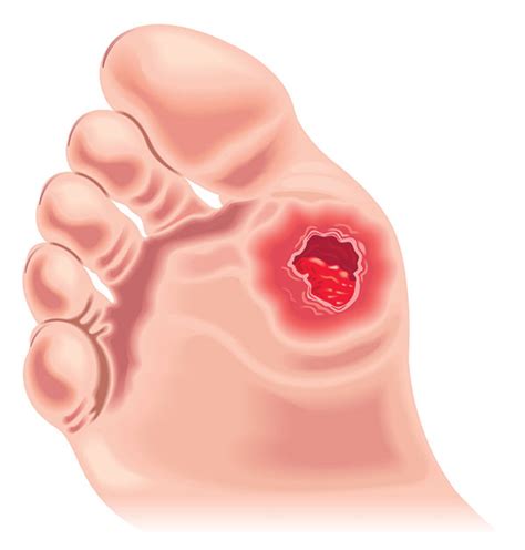 Diabetic Foot Treatment in Frisco | RNV Podiatry