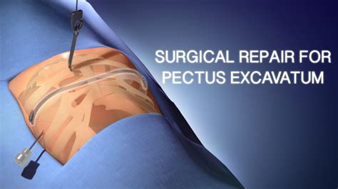 Pectus Excavatum Surgical Repair | A Cincinnati Children's Medical Animation - YouTube