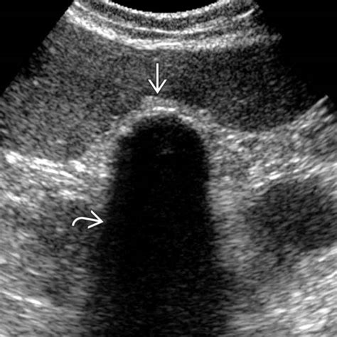 Porcelain Gallbladder Ultrasound