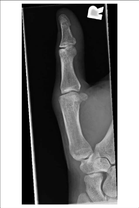 Preoperative X-ray of the right thumb (lateral). | Download Scientific ...