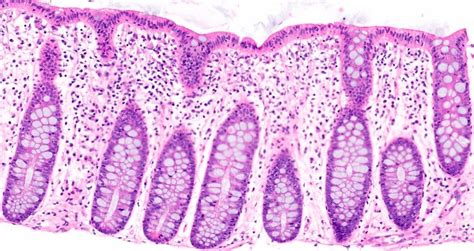 Pathology Outlines - Lymphocytic colitis