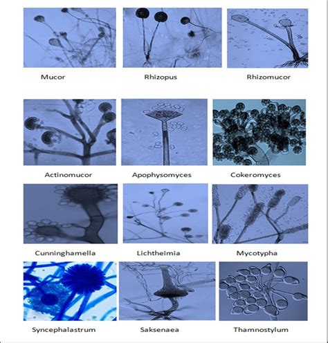 Mucormycosis: A Surge in Mucorales Fungal Infection in Post – Covid Patients in Indian States ...