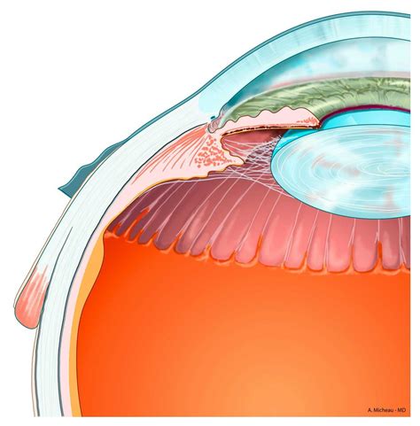 Iridocorneal Angle