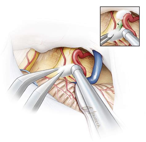 Trigeminal Neuralgia | Expert Surgeon | Aaron Cohen-Gadol MD